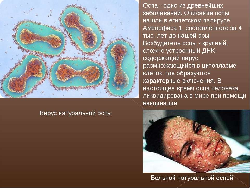 От черной до обезьяньей. Чем опасна вышедшая за пределы Африки оспа